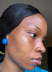 Zoom in picture of a lady's face with pimples, acne breakouts and discoloration