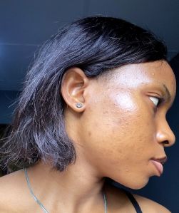Close up image of lady's face with brighter skin as acne and discoloration reduces after 3 weeks of treatment